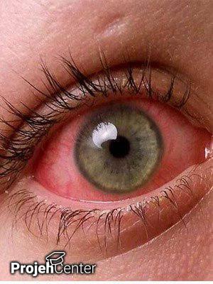 بیماری‌های چشم